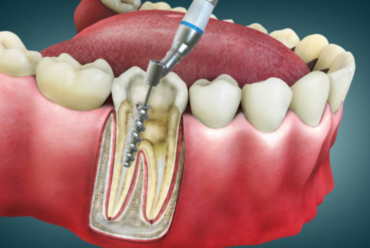 What to Expect from a Root Canal with an RCT Specialist