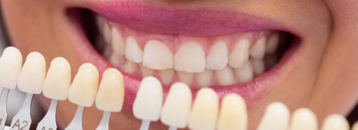 Veneers-Banner-min (1)