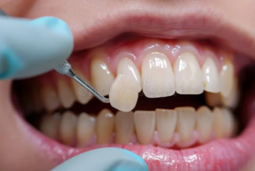 Are Veneers Right for You? Pros, Cons, and What to Consider