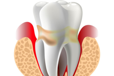 Effective Periodontal Disease Treatment: What to Expect and How It Works