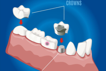 When Are Dental Crowns Necessary? Signs You Might Need One