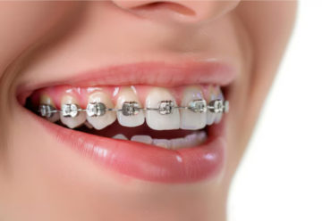 Everything You Need to Know About Dental Braces: A Comprehensive Guide