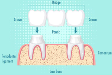 Dental Bridges Explained: A Reliable Solution for Missing Teeth