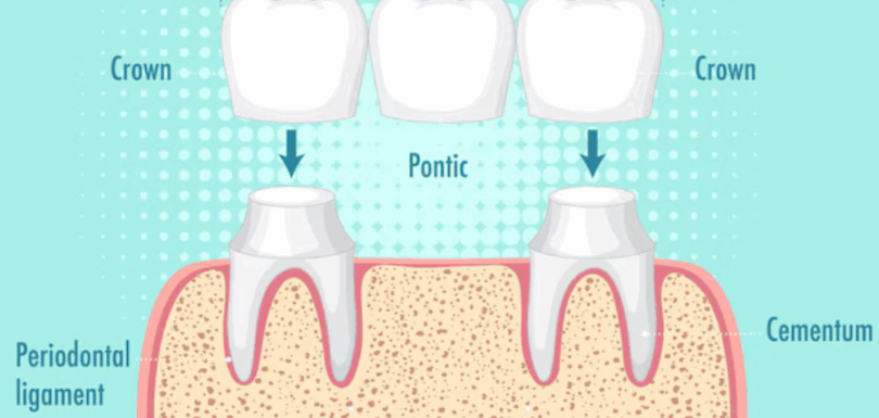 Dental Bridges