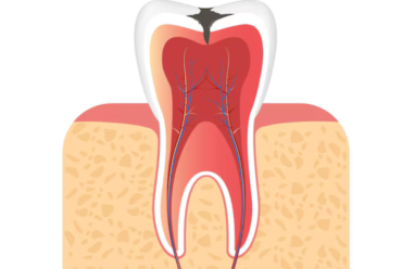 How RCT Specialists Ensure Pain-Free and Effective Root Canal Treatments