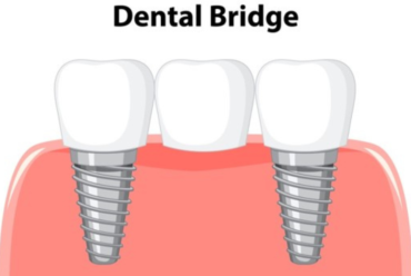 How to Care for Your Dental Bridges for Long-Lasting Results