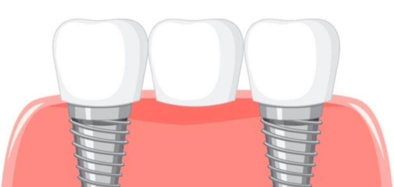 Dental bridges