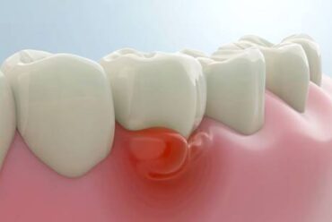 What Is the Best Cure for Gum Disease? How to Fix It?