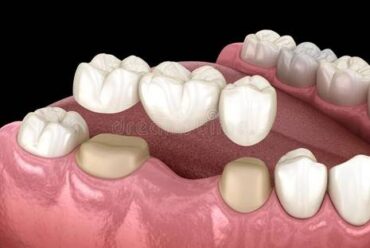 Are Dental Bridges Painful? What to Expect